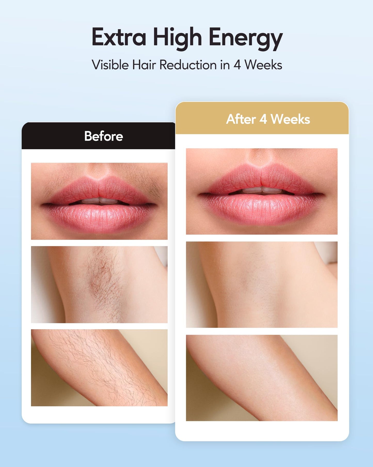 Ice Cooling IPL Hair Removal Device