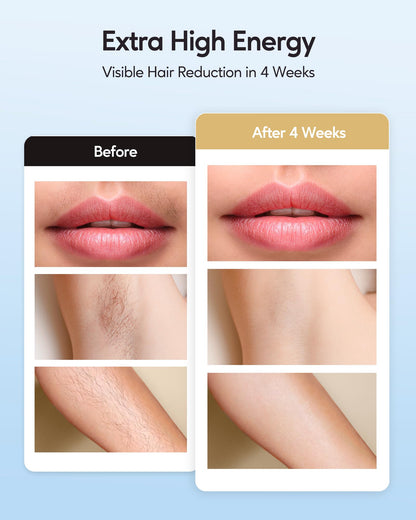 Ice Cooling IPL Hair Removal Device