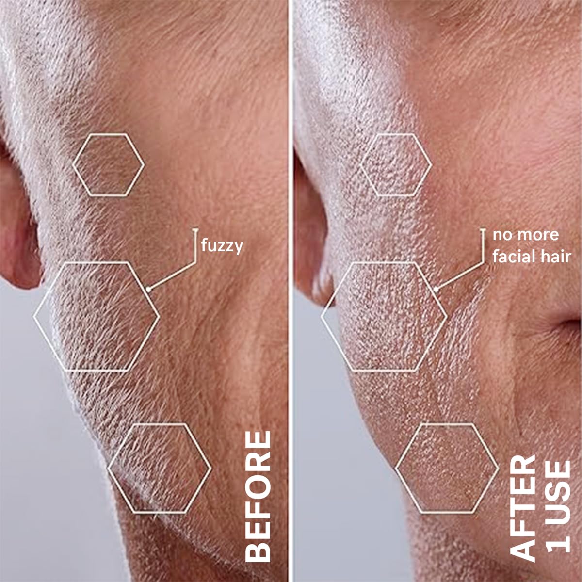 Sonic Dermaplaning Facial Exfoliation Tool