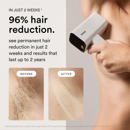 Flasher Pro IPL Hair Removal Device